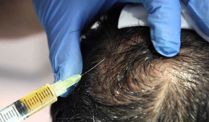 PRP For Hair Loss