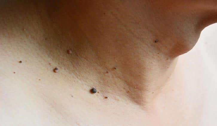 Skin Tag Removal